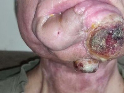 Cancer fighter